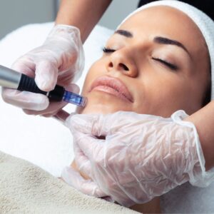 DL_MICRONEEDLING